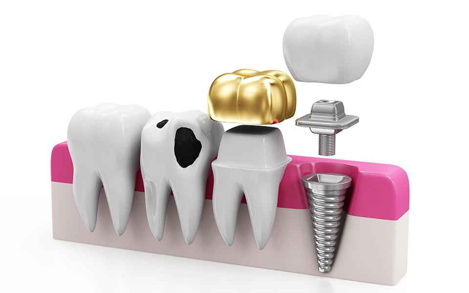 Restorative Dentistry Jackson MS - Dental Restorations