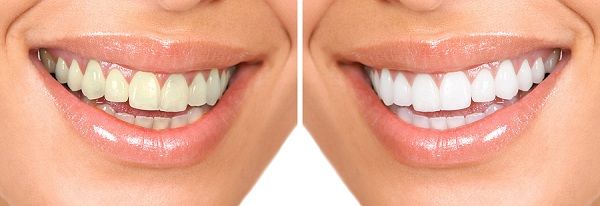Cosmetic Dentist Ridgeland & Jackson MS - Cosmetic Dentistry