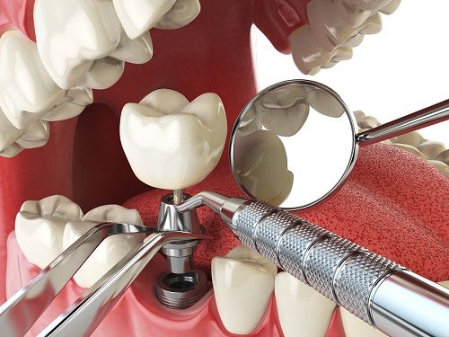 Dental Implants in Jackson MS