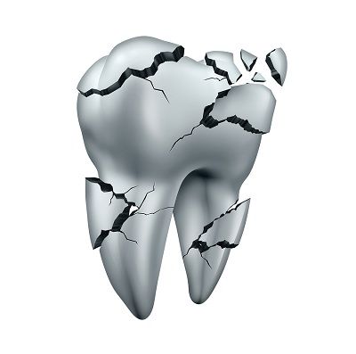 Chipped Tooth Repair Jackson MS - Chipped Teeth