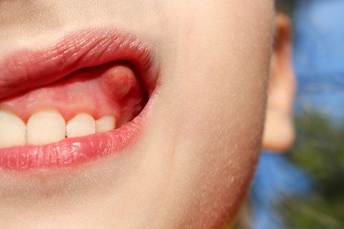 Tooth Abscess in Jackson MS
