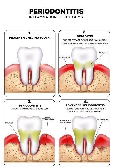 Periodontal Gum Disease Treatment