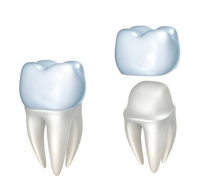 Dental Crown Replacement in Jackson MS