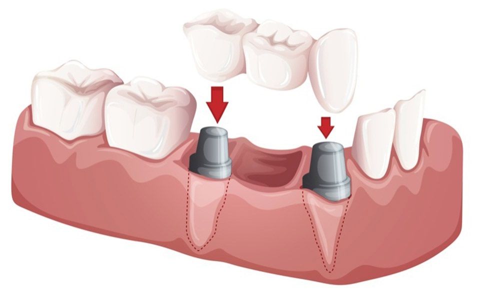 Dental Bridges Jackson MS - Teeth Bridges