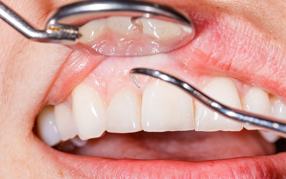 Gum Disease Treatment in Jackson MS