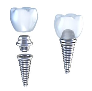 Dental Crown in Jackson, Mississippi