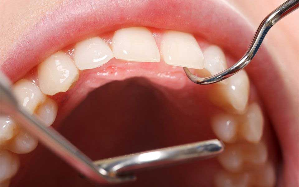 Oral Cancer Screening in Jackson, Mississippi